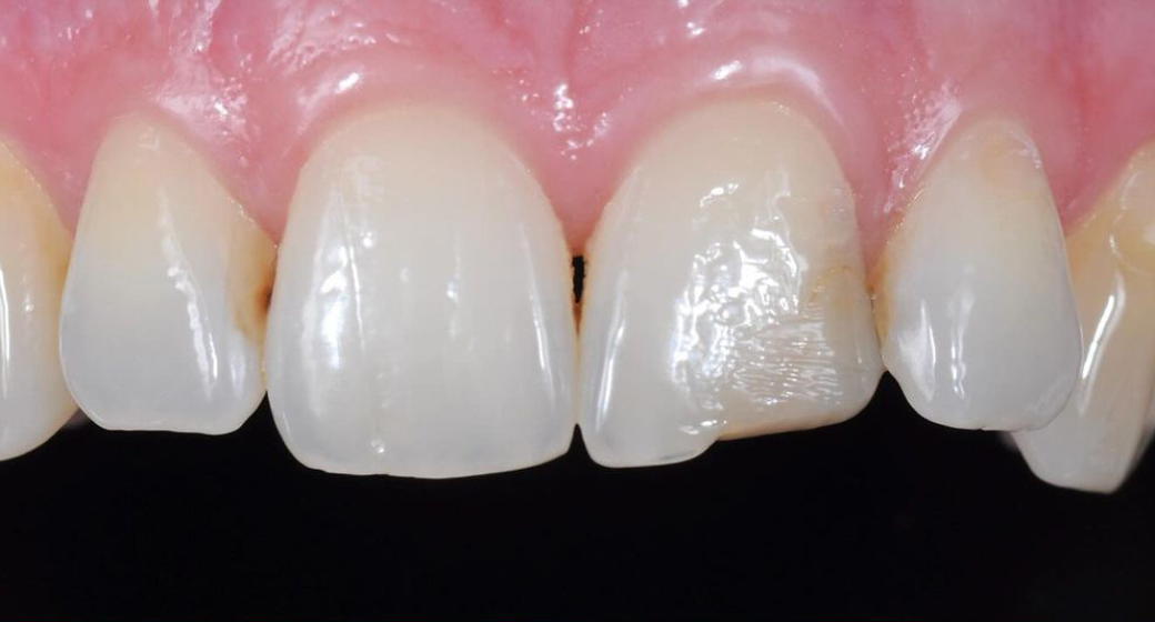 Vorher-Nachher-Bild | Veneers von Dr. med. dent. Markus Bockeloh | Ahlen f4dd765c Vorher-Bild