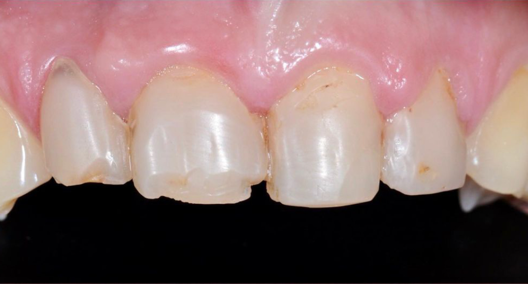 Vorher-Nachher-Bild | Veneers von Dr. med. dent. Markus Bockeloh | Ahlen f4dd765c Vorher-Bild