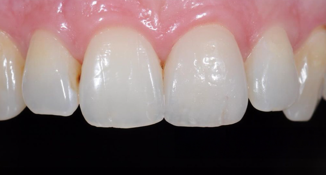 Vorher-Nachher-Bild | Veneers von Dr. med. dent. Markus Bockeloh | Ahlen f4dd765c Nachher-Bild