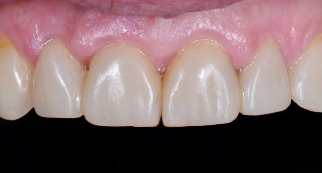 Behandlung Vorher-Nachher-Bild | Veneers von Dr. med. dent. Markus Bockeloh | Ahlen f4dd765c Vorher-Bild