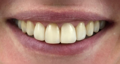 Vorher-Nachher-Bild | Veneers von Dr. med. dent. Beate Jürgens | Düsseldorf-Oberkassel ffeed84c Nachher-Bild