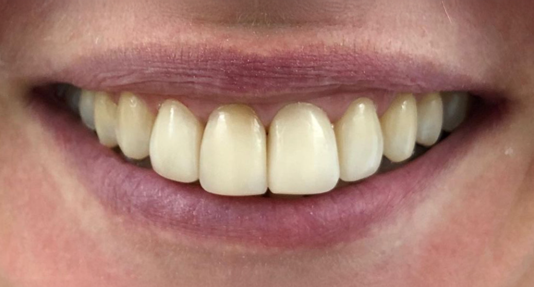 Behandlung Vorher-Nachher-Bild | Veneers von Dr. med. dent. Beate Jürgens | Düsseldorf-Oberkassel ffeed84c Vorher-Bild