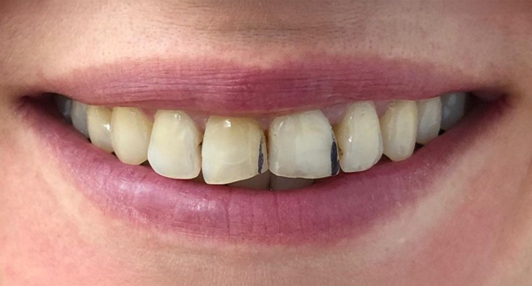 Behandlung Vorher-Nachher-Bild | Veneers von Dr. med. dent. Beate Jürgens | Düsseldorf-Oberkassel ffeed84c Nachher-Bild